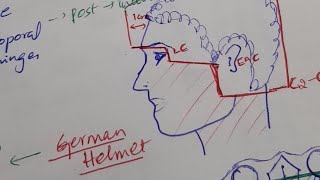 German Helmet technique [upl. by Assirak]