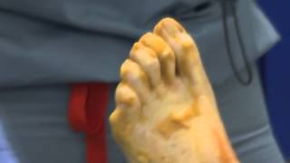 Nailing Down a Solution for Hammertoe [upl. by Tracey]