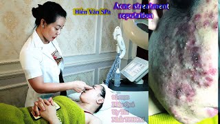 acneblackheadsacne treatmentcystic điều trị mụnnặn mụn hiệu quả tại Hien Van Spa383Đại Nghĩa [upl. by Aicenra]