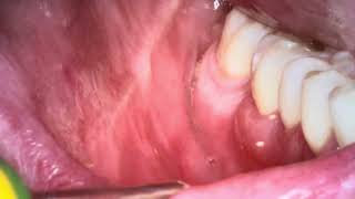 Contact stomatitis oral sores part 113 [upl. by Anelleh]