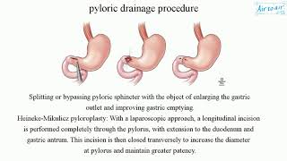 pyloric drainage procedure [upl. by Ahseined3]