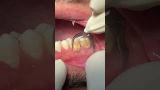 Cleaning teeth 🦷 dental scaling satisfying [upl. by Fiske587]