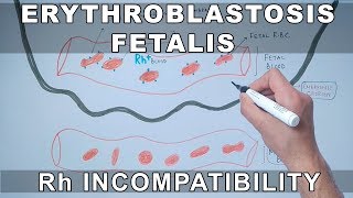 Erythroblastosis fetalis  Rh Incompatibility [upl. by Roda911]