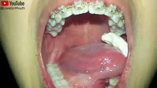 Girl with braces eats a chewy candy she chews it to a pulp and then swallows it chewing uvula [upl. by Leugim]