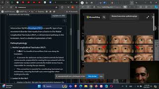 Neurology and Ophthalmology InterNuclear Ophthalmoplegia INO MLF lesion [upl. by Flavian149]
