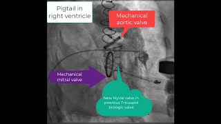 Tricuspid valve in valve implantation MyVal balloon expandable valve in Epic Bioprosthetic valve [upl. by Rehpetsirhc]