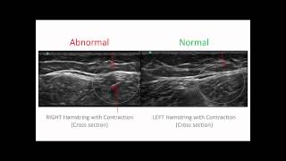 Hamstrings Injury Diagnosis [upl. by Kress]