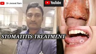 Stomatitis treatment and management [upl. by Tulley303]