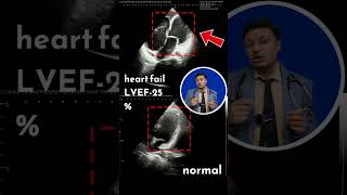 Heart failure animation video [upl. by Retep]