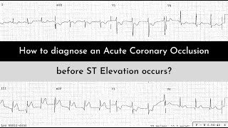 STEMINSTEMI vs OMINOMI A Paradigm Shift in ECG interpretation of MI [upl. by Ylagam]