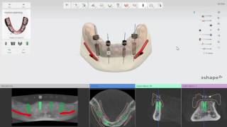 3Shape Implant Studio – Zahnloser Kiefer  4 Implantat Planung durchführen [upl. by Xineohp230]