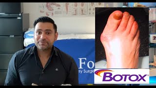 Botox for Bunions part 1  Non Surgical Solution to Bunions [upl. by Wurster]