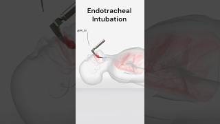 Endotracheal Intubation [upl. by Leerzej]