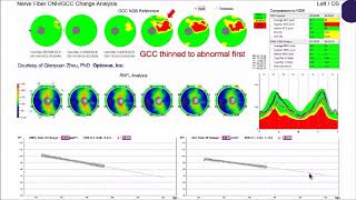 OCT What should I image –NFL ganglion cell or both [upl. by Asiaj538]