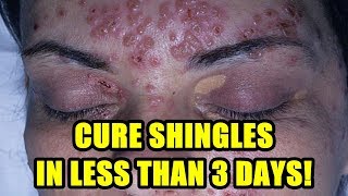 Shingles Treatment 2018  Cure Shingles on Face and Shingles in The Eye [upl. by Lajet607]