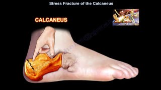 Stress Fracture of the Calcaneus  Everything You Need To Know  Dr Nabil Ebraheim [upl. by Hellah876]