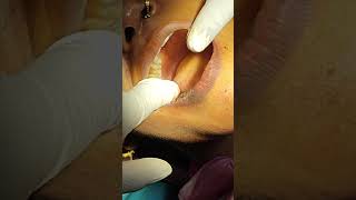 wisdom teeth removal maa ambe dental clinic thana bhipur bhagalpurdentalhealth bollywood [upl. by Harobed]