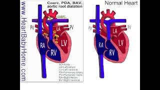 44 Coarctation of the Aorta bicuspid aortic aortic root dilation [upl. by Ahsimot]