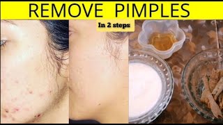 2 Simple Steps To Remove Pimples  How To Get A Rid Of Pimples [upl. by Doowyah]