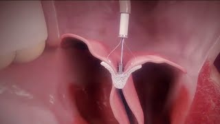 Santé  Cardiologie  une pince pour traiter les valves [upl. by Llien749]