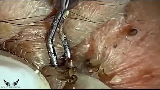 Elderly Hidden Blackhead Removal  Cystic Acne Treatment  Pimple Popping Spa  Acne on Face  079 [upl. by Aneres279]