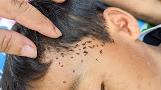 Remove All Lice From Long Hair amp Black Hair  Picking Out All Lice From Head 0 5 [upl. by Nylsirhc]