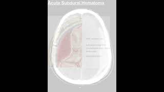 subdural hematoma 3d animation  Acute subdural hemorrhage ct scan  subdural hematoma radiology [upl. by Modla]