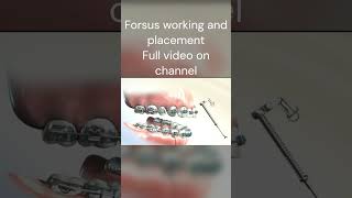 Forsus fixed functional appliance orthodontics braces dentist [upl. by Dagney554]