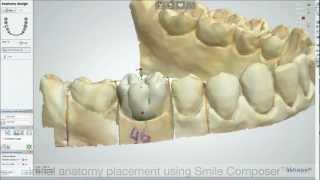 Dental System™ 2013  Inlay [upl. by Osyth]