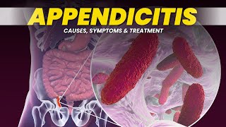 Understanding Appendicitis Causes Symptoms and Treatment  3D Animation [upl. by Grimonia]