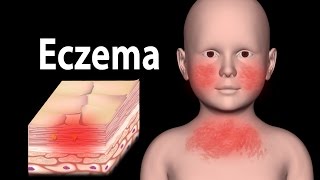 Eczema Animation [upl. by Vocaay]