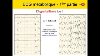 12a ECG métabolique 1 Hyperkaliemie Dr Taboulet [upl. by Kirwin]