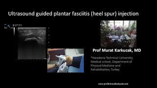 Ultrasound guided plantar fasciitis heel spur injection [upl. by Anirok]