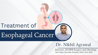 Esophageal Cancer  Advanced Esophageal Cancer  Treatment  Dr Nikhil Agrawal  Delhi [upl. by Reema]