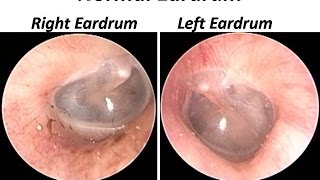 Otoendoscopy  How Normal Ear Drum  Tympanic Membrane  Look Like [upl. by Clements]