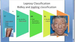 Pathology 160 a Leprosy Classification Difference Tuberculoid Lepromatous Ridley jopling TT BT BB LL [upl. by Yankee]