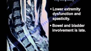 Cervical Spine Myelopathy  Everything You Need To Know  Dr Nabil Ebraheim [upl. by Adlemy]