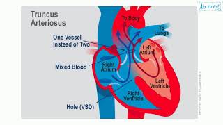 truncus arteriosus [upl. by Tamiko456]