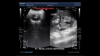 Renal Cystic Nephroma [upl. by Nibor]