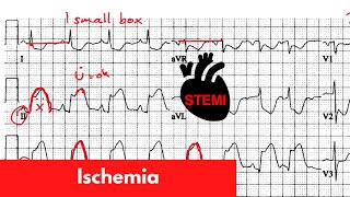 ECG Basics  STEMI  For DO MD NP PA Part 6 [upl. by Paluas]