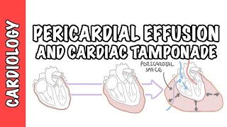 Cardiac Tamponade  pericardial effusion causes pathophysiology investigations and treatment [upl. by Artemus]