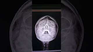 PNS XRAYparanasal sinusPNS Headdoctor Head anatomy nasal septum is deviated to right side [upl. by Adnih380]