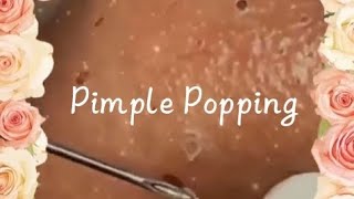 Pimple amp Blackheads Popping  10 [upl. by Wilser]