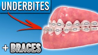 How Do Braces Fix Underbites  Premier Orthodontics [upl. by Aneeles]