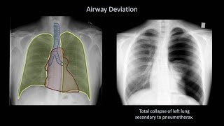 How to Interpret a Chest XRay Lesson 4  Airways Bones and Soft Tissues [upl. by Buchanan]