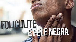 FOLICULITE E PELE NEGRA [upl. by Marylinda]