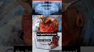 Case of Odontogenic keratocyst  OKC  Cyst of jaw  cystic lesion of jaw  Mandible Ressection [upl. by Farra]