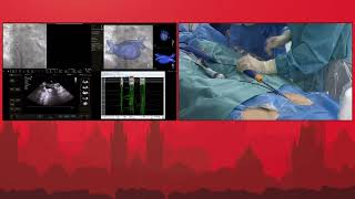 PR 2022 APRIL 25 Live demonstrations II – AF ablation  Part B [upl. by Berg]