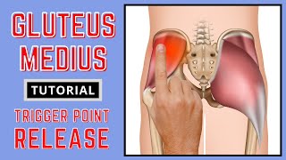 Trigger Point Release  Gluteus Medius [upl. by Armalda]