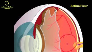 Eye Floaters Retinal Tears and Retinal Detachments [upl. by Matheny27]